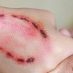 Mordeduras: ¿cuándo hay riesgo de rabia?